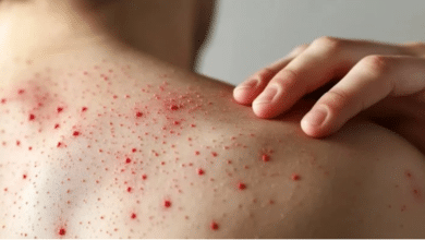 Hopelchén en alerta aumentan los casos de sarampión en Campeche