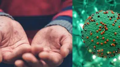 Nuevo caso de sarampión en Ciudad del Carmen