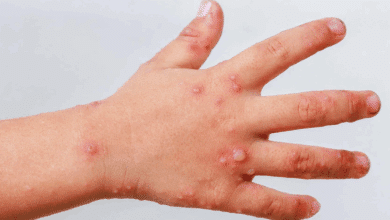 Regreso parcial a clases en Calkiní tras brote de Coxsackie