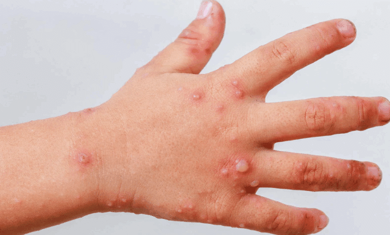 Regreso parcial a clases en Calkiní tras brote de Coxsackie