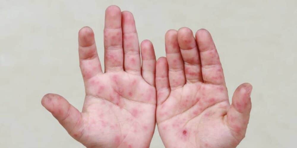 Suman 23 casos del Virus Coxsackie en Calkiní