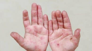 Suman 23 casos del Virus Coxsackie en Calkiní