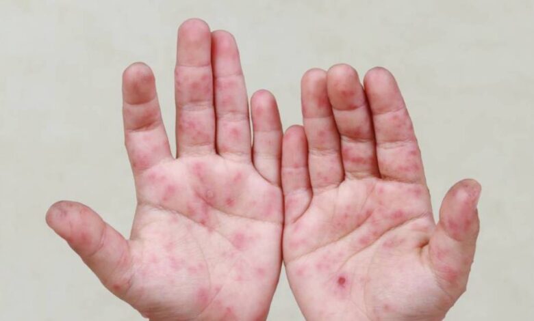 Suman 23 casos del Virus Coxsackie en Calkiní