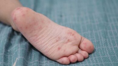 Campeche presenta nuevos casos de coxsackie