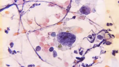 Cáncer cervicouterino en Campeche 101 mujeres enfrentan diagnósticos tardíos