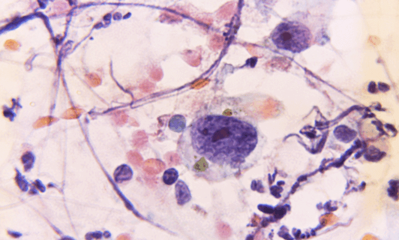 Cáncer cervicouterino en Campeche 101 mujeres enfrentan diagnósticos tardíos