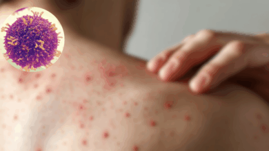 Crisis sanitaria México rebasa los 5,000 casos de sarampión y lidera la mortalidad en el continente