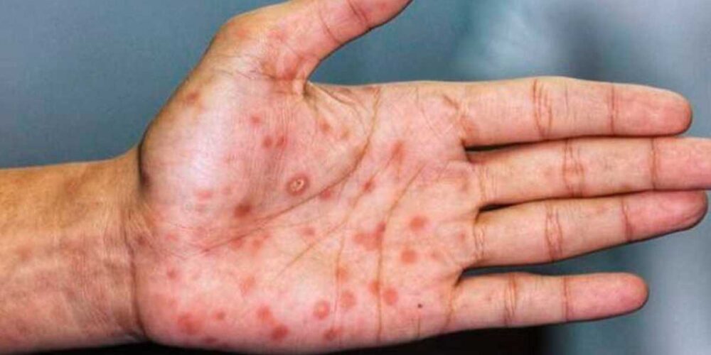 Casos de varicela en Campeche van en aumento