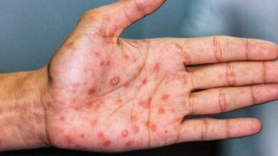 Casos de varicela en Campeche van en aumento