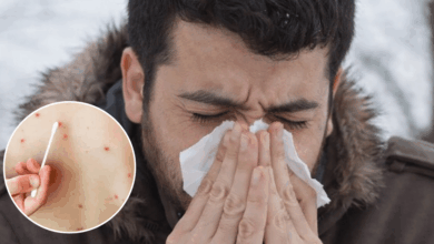 Síntomas y contagio del sarampión: ¿Cuánto tiempo tarda en manifestarse el virus?