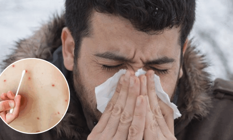 Síntomas y contagio del sarampión: ¿Cuánto tiempo tarda en manifestarse el virus?