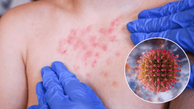 OPS emite alerta epidemiológica por brote de sarampión; México lidera casos en América