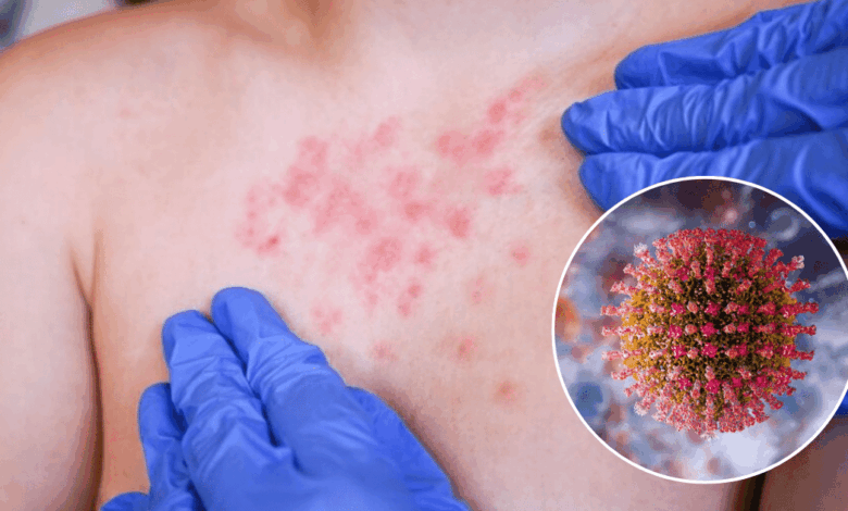 OPS emite alerta epidemiológica por brote de sarampión; México lidera casos en América