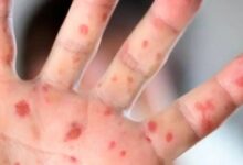 Preocupa caso confirmado de sarampión en escuela de Campeche