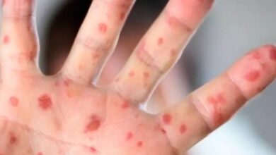 Preocupa caso confirmado de sarampión en escuela de Campeche