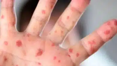 Preocupa caso confirmado de sarampión en escuela de Campeche