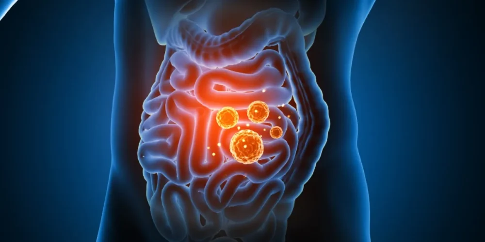 infecciones intestinales superan 10 mil en campeche