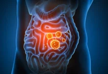 infecciones intestinales superan 10 mil en campeche