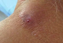 suman nuevos casos de miasis humana en campeche, suman 13