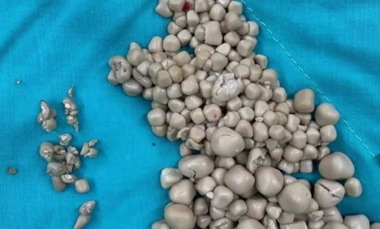 joven de 20 años llega con fiebre y médicos encuentran más de 300 piedras en un riñón