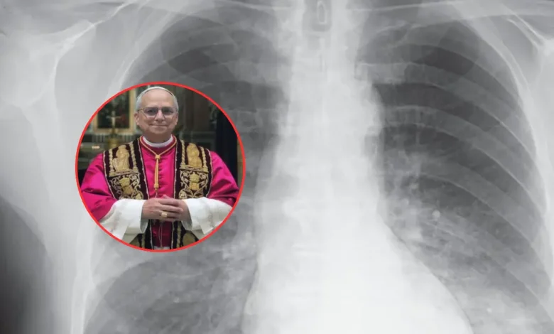 qué es el adenocarcinoma pulmonar, el tumor detectado al papa león xiv