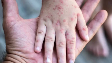 sarampión en méxico estados más afectados